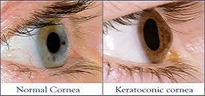 Symptoms & signs of Keratoconus 