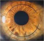 New Vistas In Surgical Treatment Of Keratoconous : Intacs (Intra Corneal Ring Segments)