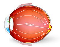 Glaucoma Treatment
