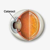 Cataract Treatment in mumbai