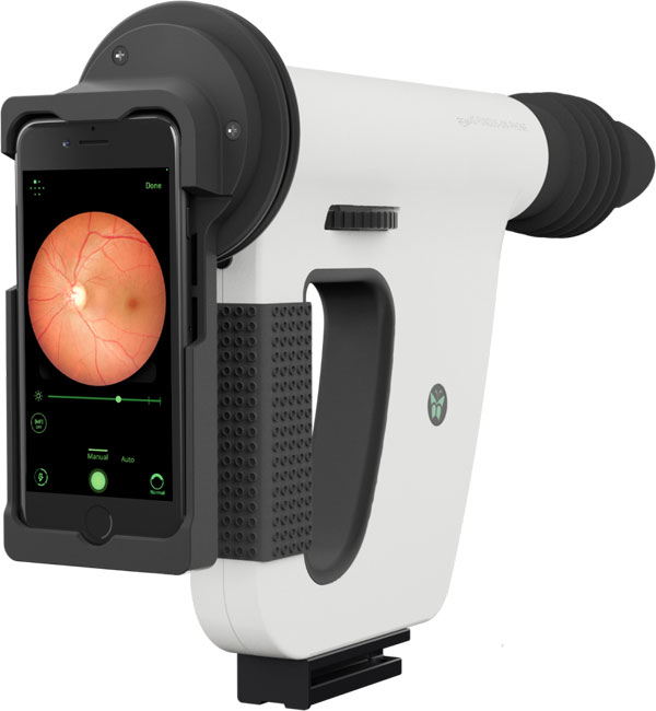 diabetic retinopathy (DR)