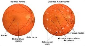  Diabetic Retinopathy