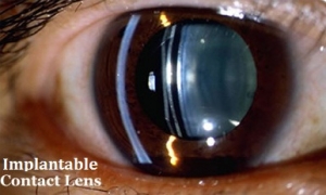 ICL (implantable collamer lenses) 