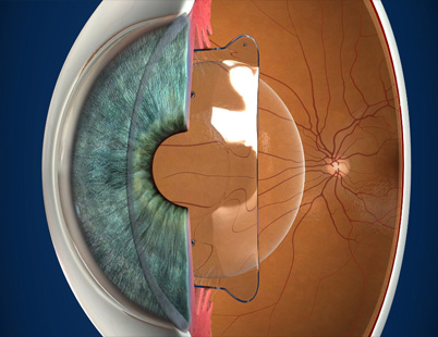 Phakic Lens (ICL) Surgery?
