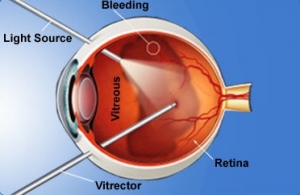 Treatment for Retinal Detachment
