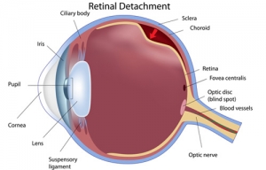 Retinal Tear / Detachment