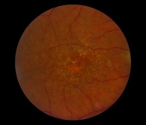 Dry AMD can be a precursor to wet AMD